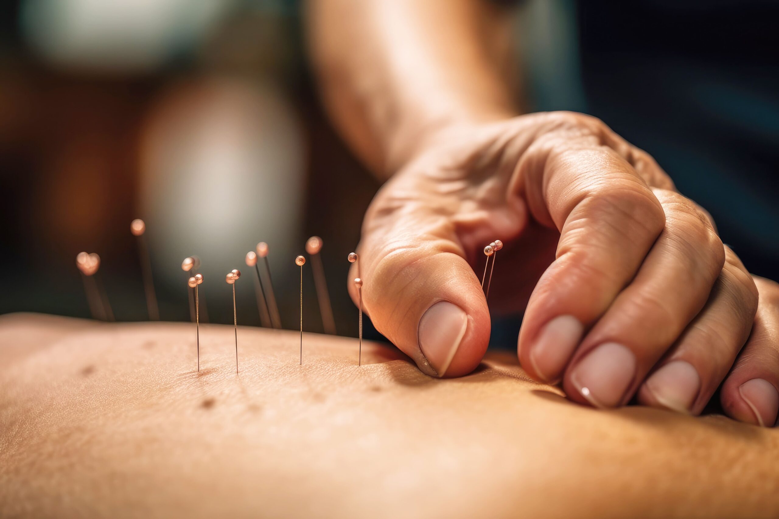  Acupuncture for Better Sleep: Can It Help with Insomnia?